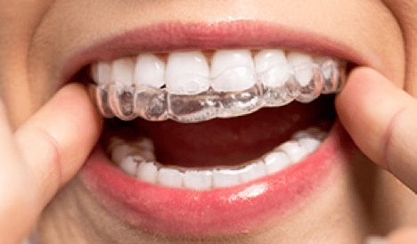 Invisalign for Raleigh Teens